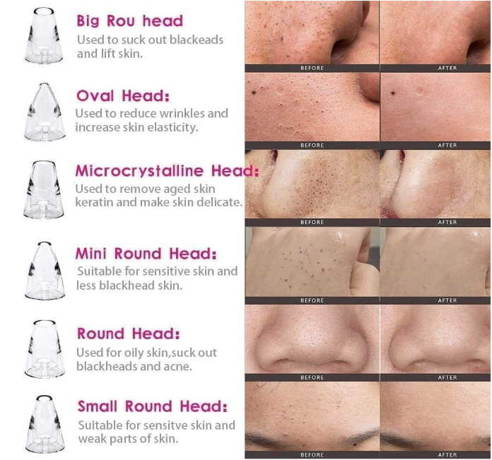 6 in 1 Multi-function Blackhead Remover Tools | Electric Derma suction Machine | USB Rechargeable Acne Pimple Pore Cleaner Vacuum tool - Facial Cleanser Device for Nose & Skin Care (6 in 1 Derma Suction)