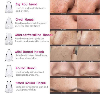 6 in 1 Multi-function Blackhead Remover Tools | Electric Derma suction Machine | USB Rechargeable Acne Pimple Pore Cleaner Vacuum tool - Facial Cleanser Device for Nose & Skin Care (6 in 1 Derma Suction)